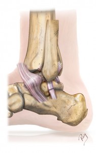 Ankle instability | Orthopedic Surgical Center Geneva